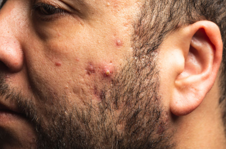 How To Reduce Steroid Acne